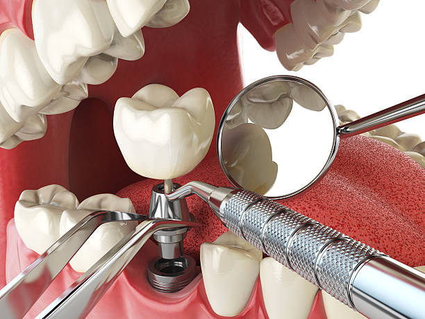 Best Emergency Cosmetic Dentistry (e.g., broken veneers) in State College, PA